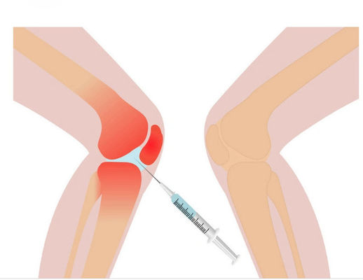 Solución de mesoterapia para el dolor de rodilla de 3 ml Ácido hialurónico no reticulado