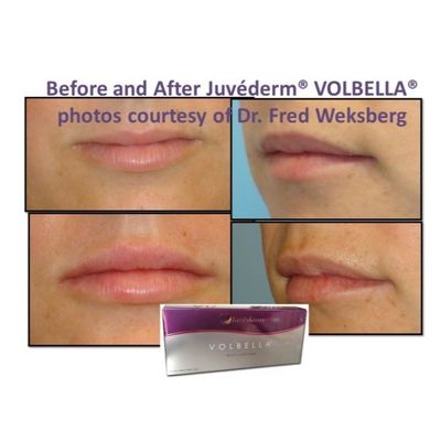 Ácido hialurónico Juvederm Gel de relleno facial Piel lisa e impecable