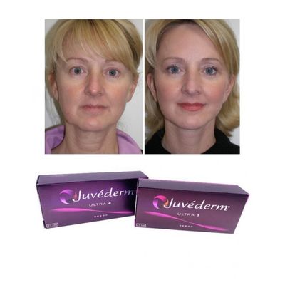 6-9 meses de duración Juvederm Dermal Filler Gel para la compra en línea y en la tienda