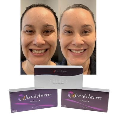Juvederm Relleno de labios dérmicos con ácido hialurónico