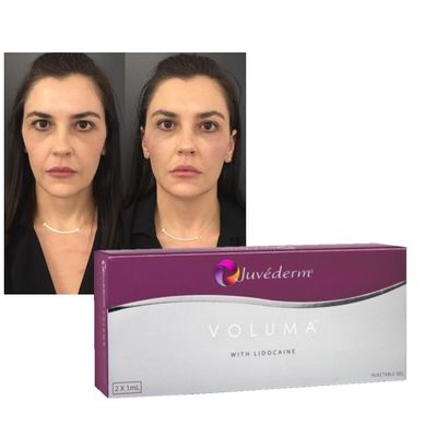 Ácido hialurónico Gel de relleno dérmico Juvederm Rolos mejillas Rejuvenecimiento mejora fórmula