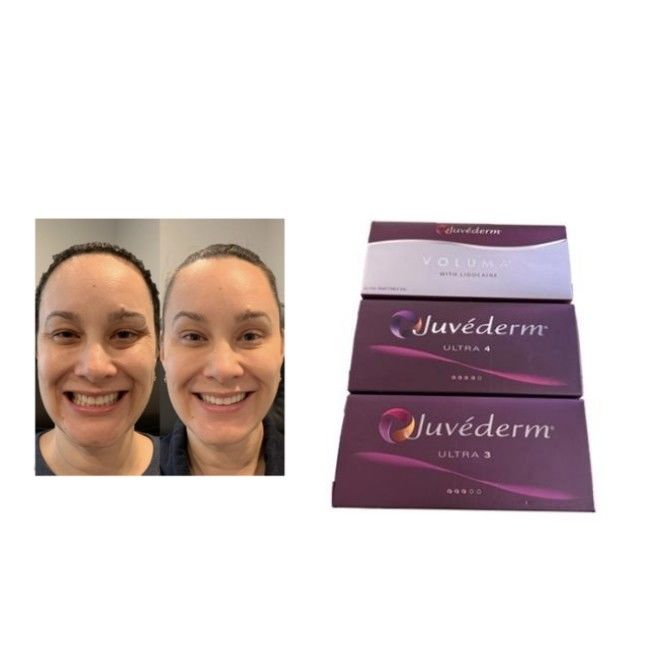 Ácido hialurónico reticulado Juvederm Relleno Dérmico Ultra3 Ultra4 Voluma Condiciones de almacenamiento Evitar la congelación Gel inyectable para la restauración del volumen facial